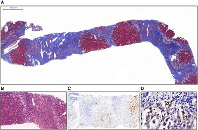 Primary biliary cholangitis with features of autoimmune hepatitis in a 19-year-old adolescent with 14q24.1q24.2 deletion: a case report